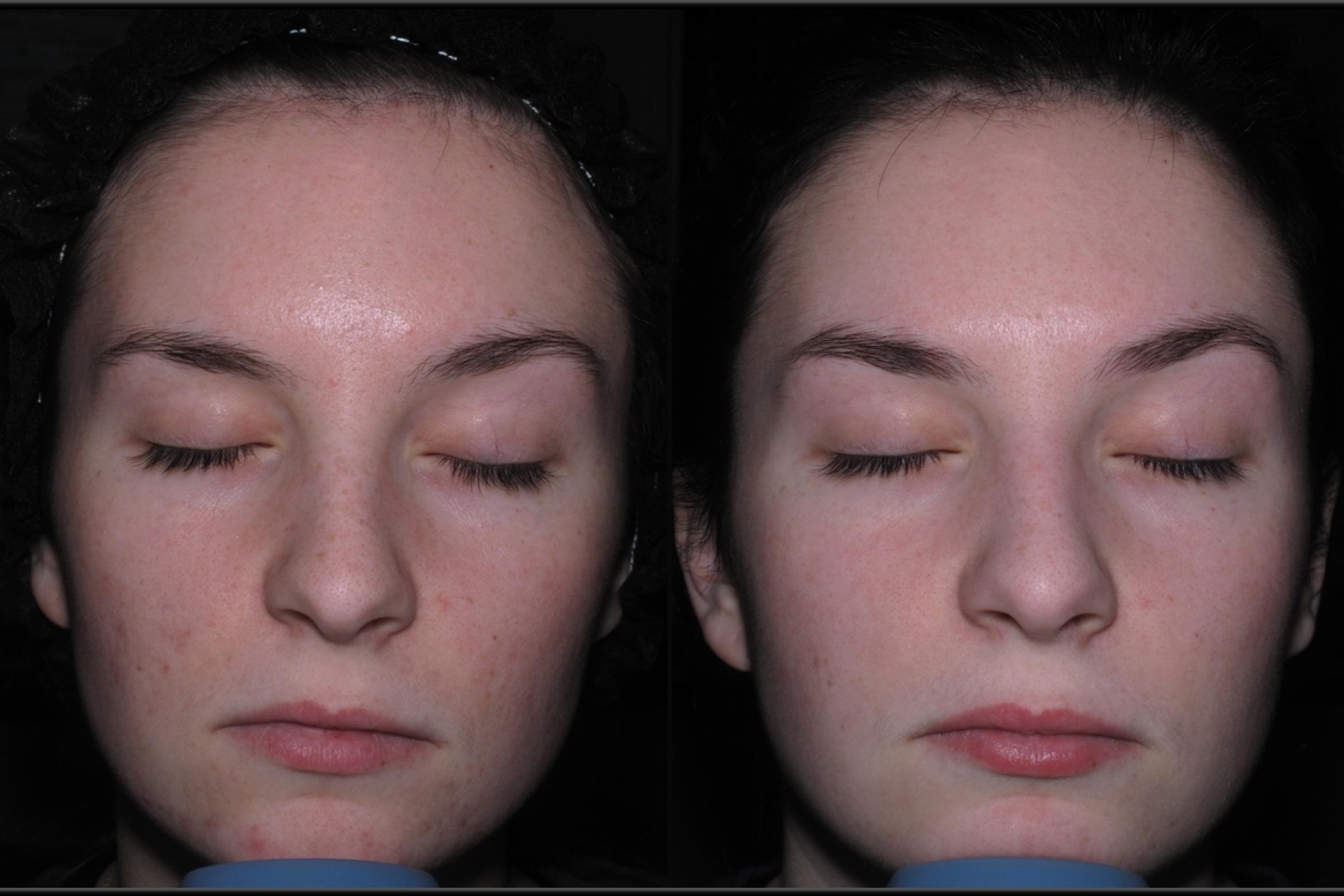 Before & After Chemical Peels Case 10 Front View in Toledo, OH