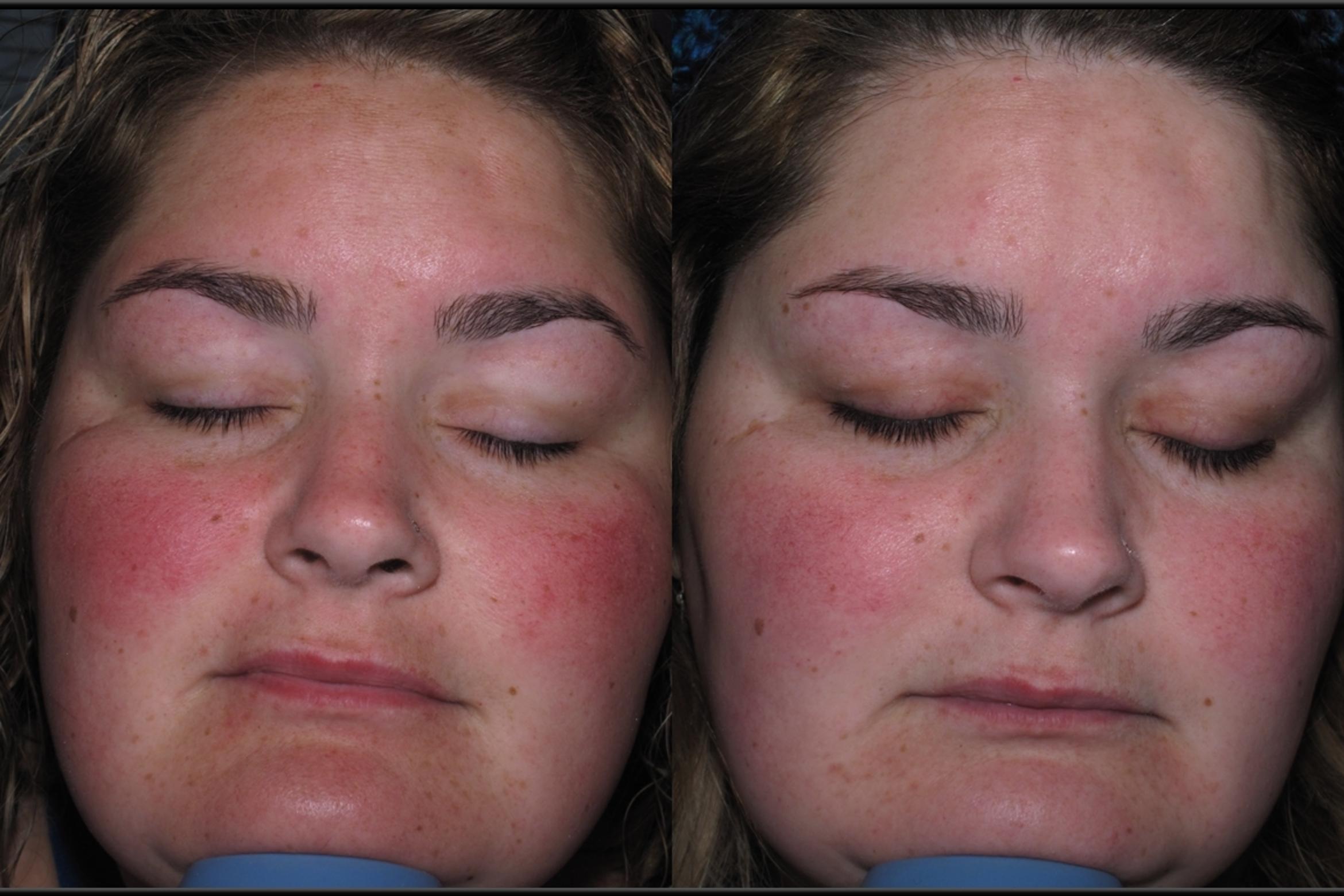 Before & After Chemical Peels Case 11 Front View in Toledo, OH