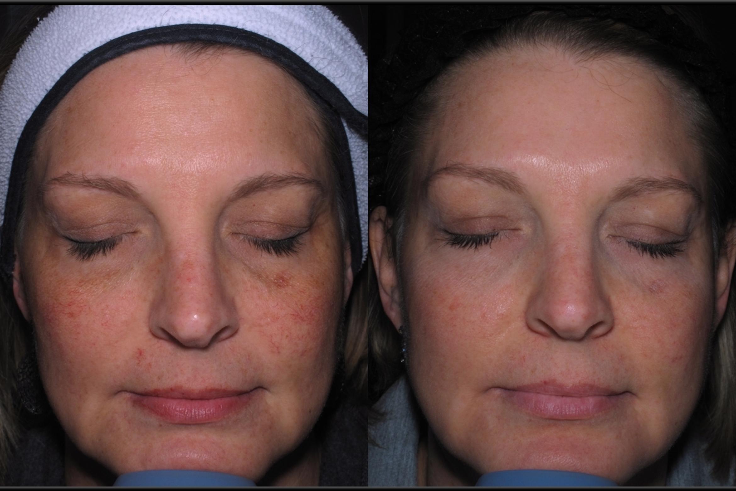 Before & After Chemical Peels Case 13 Front View in Toledo, OH