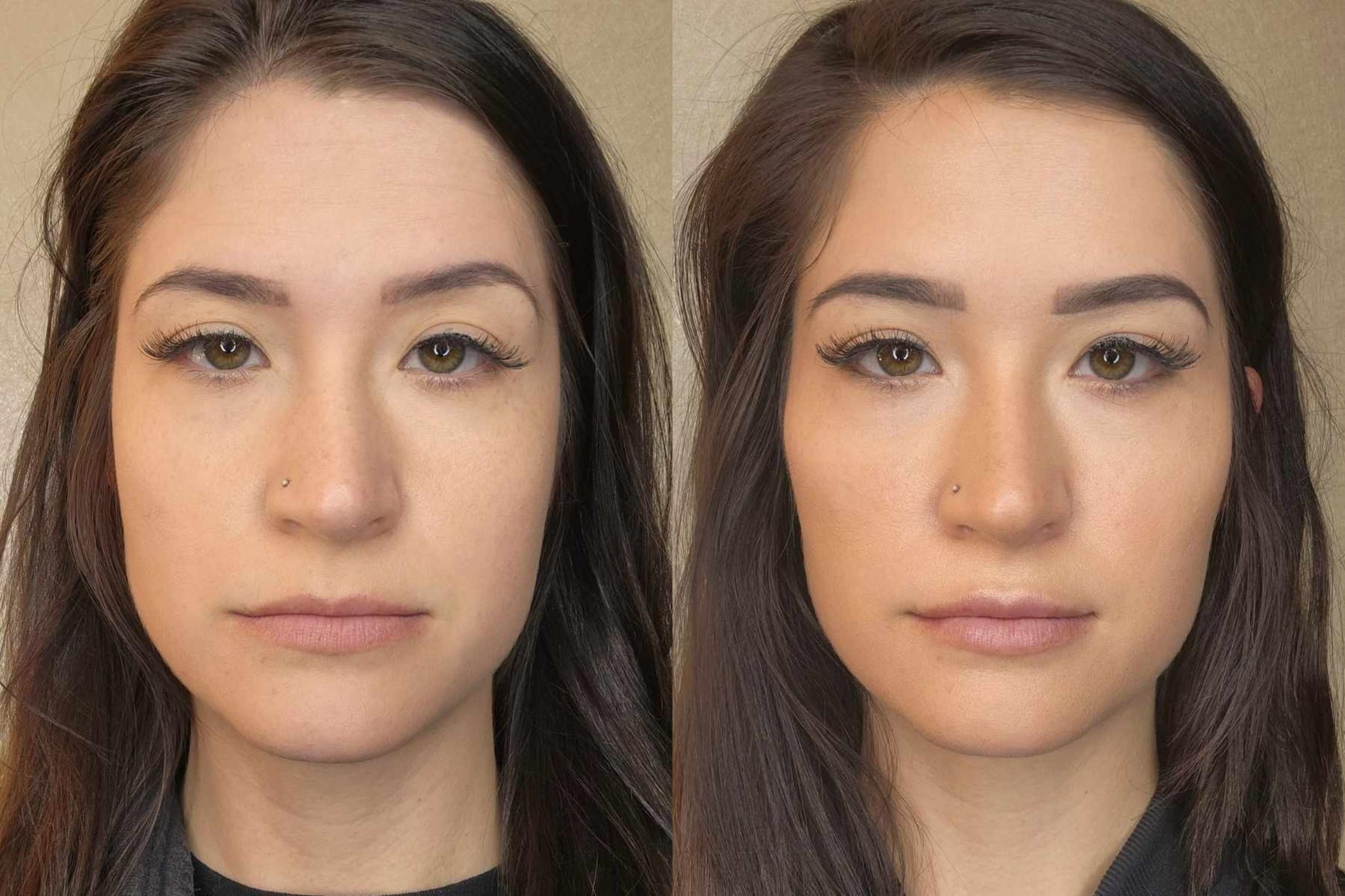 Before & After Dermal Fillers Case 1 Front View in Toledo, OH