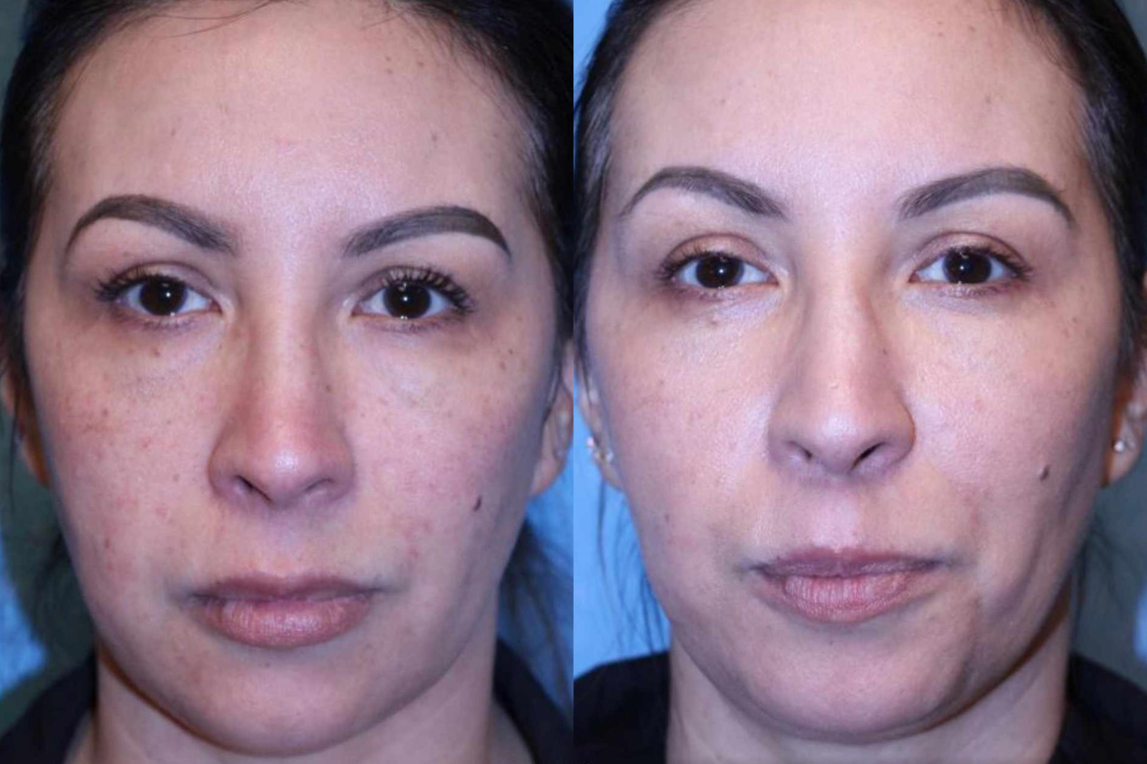 Before & After Dermal Fillers Case 15 Front View in Toledo, OH