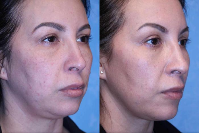 Before & After Dermal Fillers Case 15 Right Side View in Toledo, OH