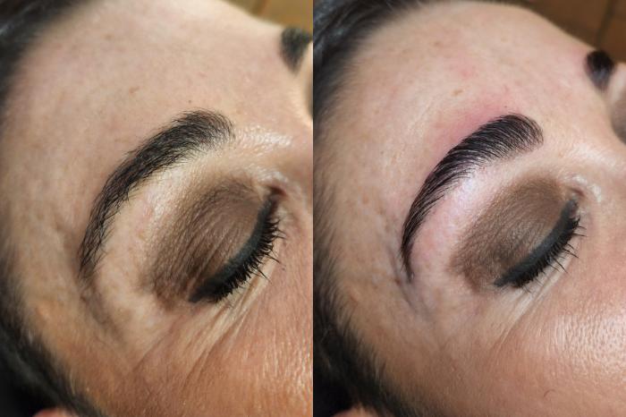 Before & After Skin Care Case 3 Right Side View in Toledo, OH