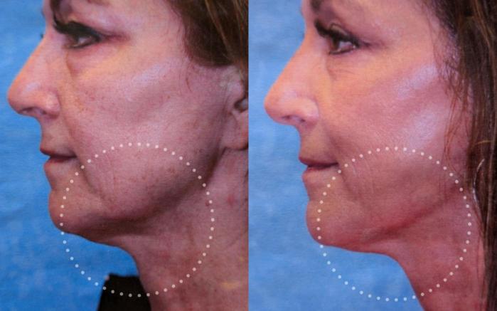 Before & After Sofwave™ Skin Tightening Case 22 Left Side View in Toledo, OH